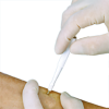 Disposable Skin Biopsy Punches 1mm-12mm - Acuderm