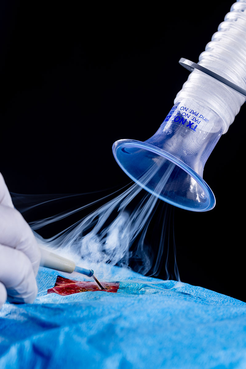 Smoke venturi effect flows up into a surgical smoke evacuator